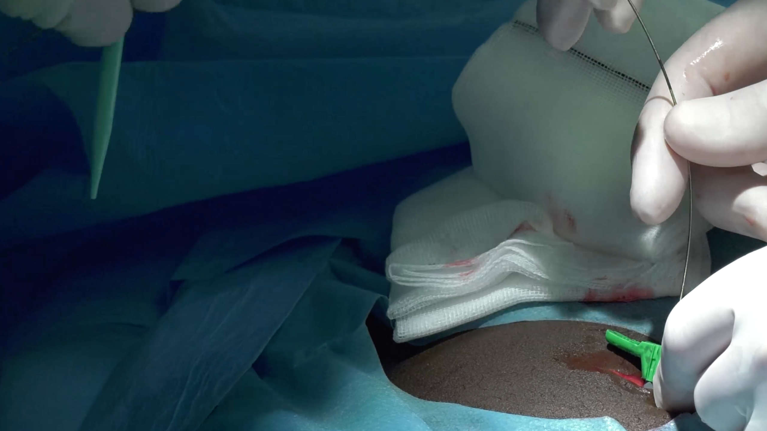 Image for task: Dilator Insertion