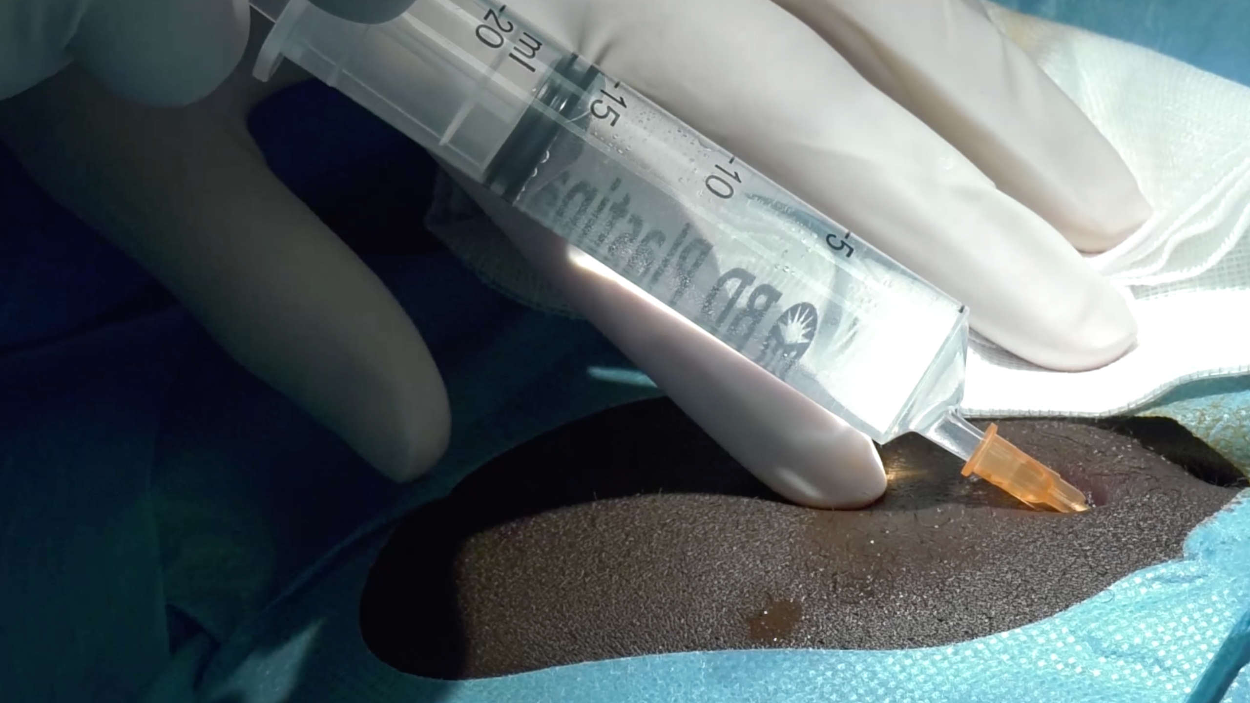 Image for task: Local Anaesthetic