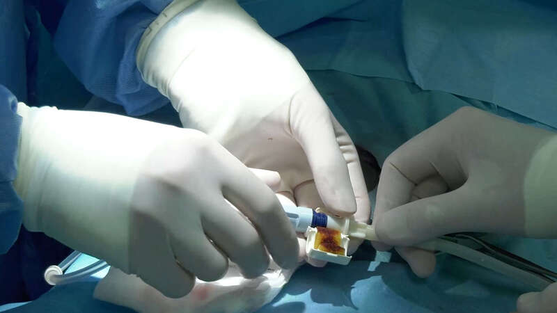 Image previewing the Peritoneal Catheter Placement lesson