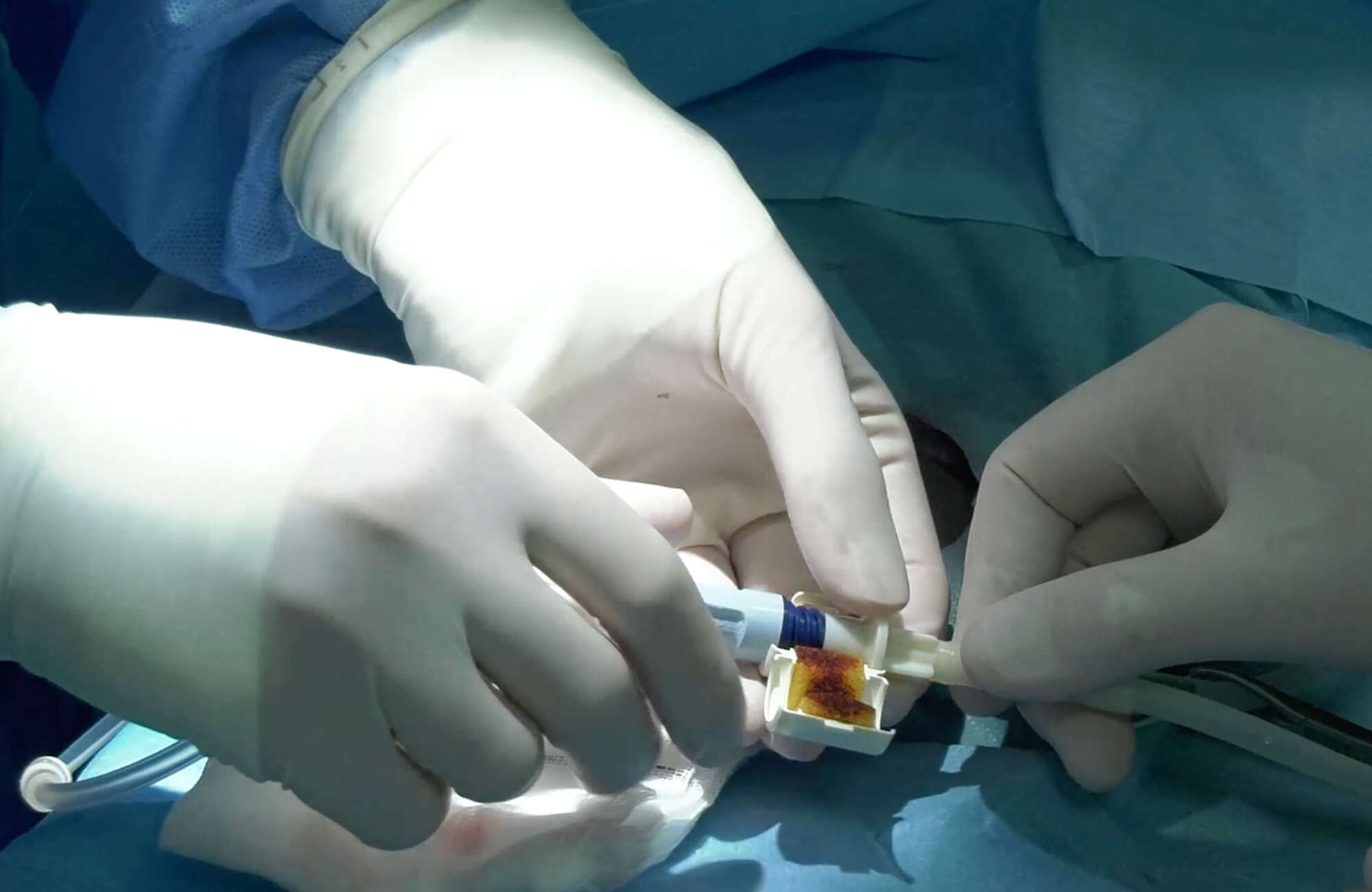 Peritoneal Catheter Placement